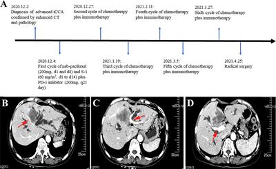 Case report: Conversion therapy for advanced intrahepatic cholangiocarcinoma using PD-1 inhibitor plus S-1 and nab-paclitaxel